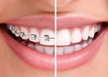 Teeth Straightening Template