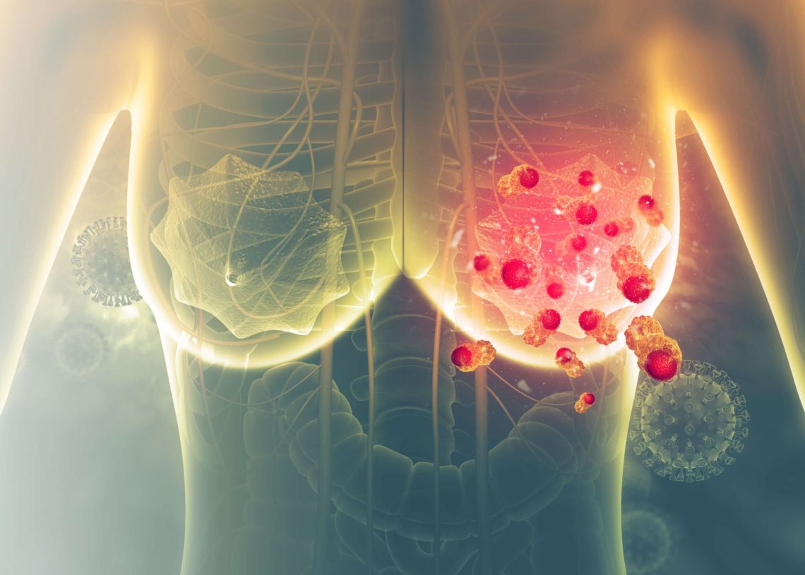 Breast Cancer Treatment and Diagnosis