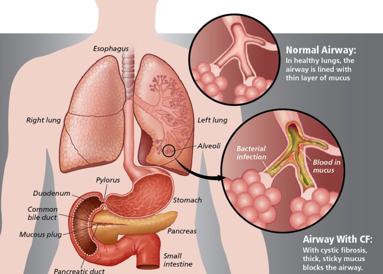 All you need to know about Cystic fibrosis (CF)