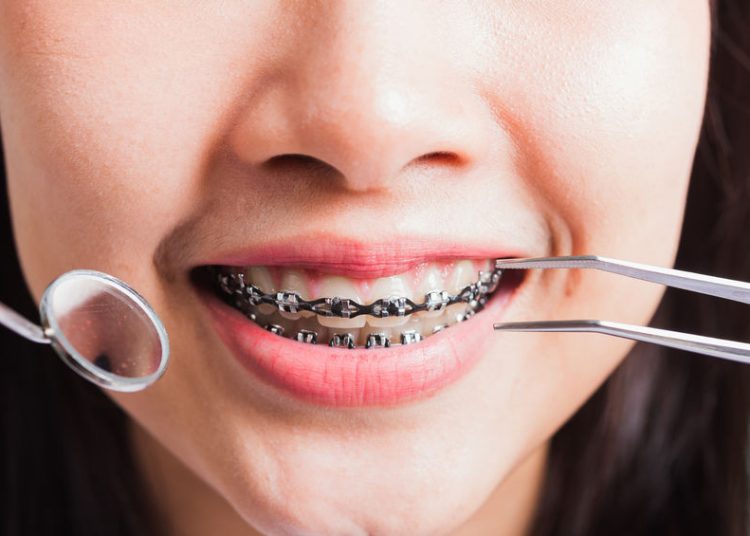 Braces Or Invisalign : Choosing The Right Treatment